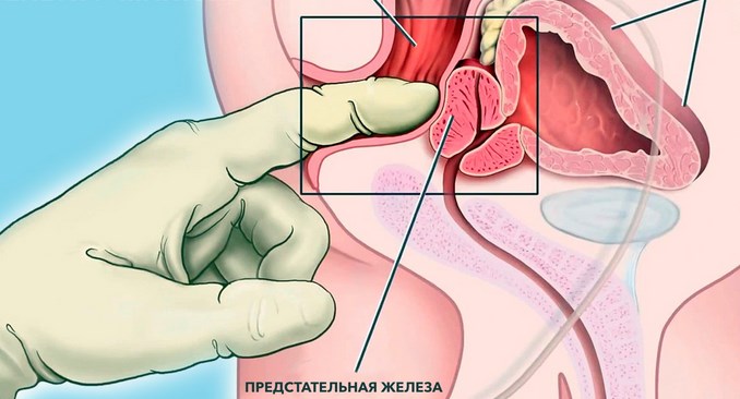 Массаж простаты